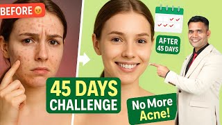 How to Treat Acne , Pimple Naturally: Ayurvedic Herbs + Diet for Clear Skin