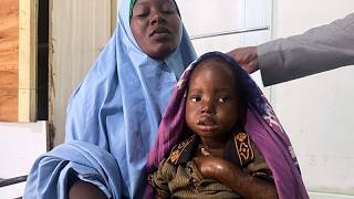 YouTube video thumbnail:  Somalia’s Children Face Deadly Malnutrition Crisis as aid Dwindles 