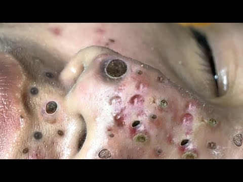 Blackhead Removal With Sac Dep Spa @100074545