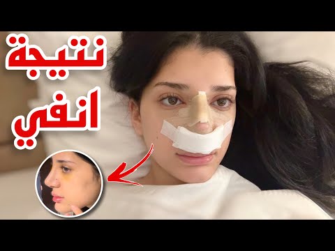 اخيرا نتيجة انفي بعد عملية التجميل.. 👃🏻