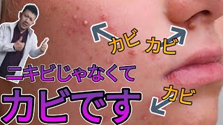 ニキビだと思っていも実はカビです！このカビは放置すると全身に広がります！