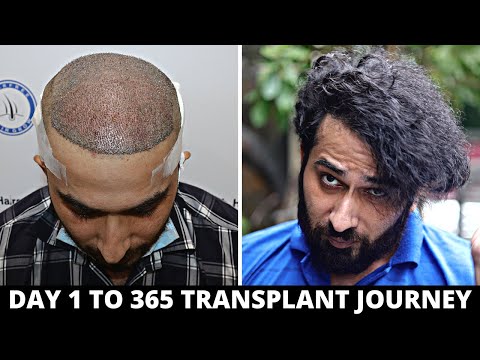 FUE Hair Transplant Timeline I Day 1 to Day 365 I Before & After | Born Creator
