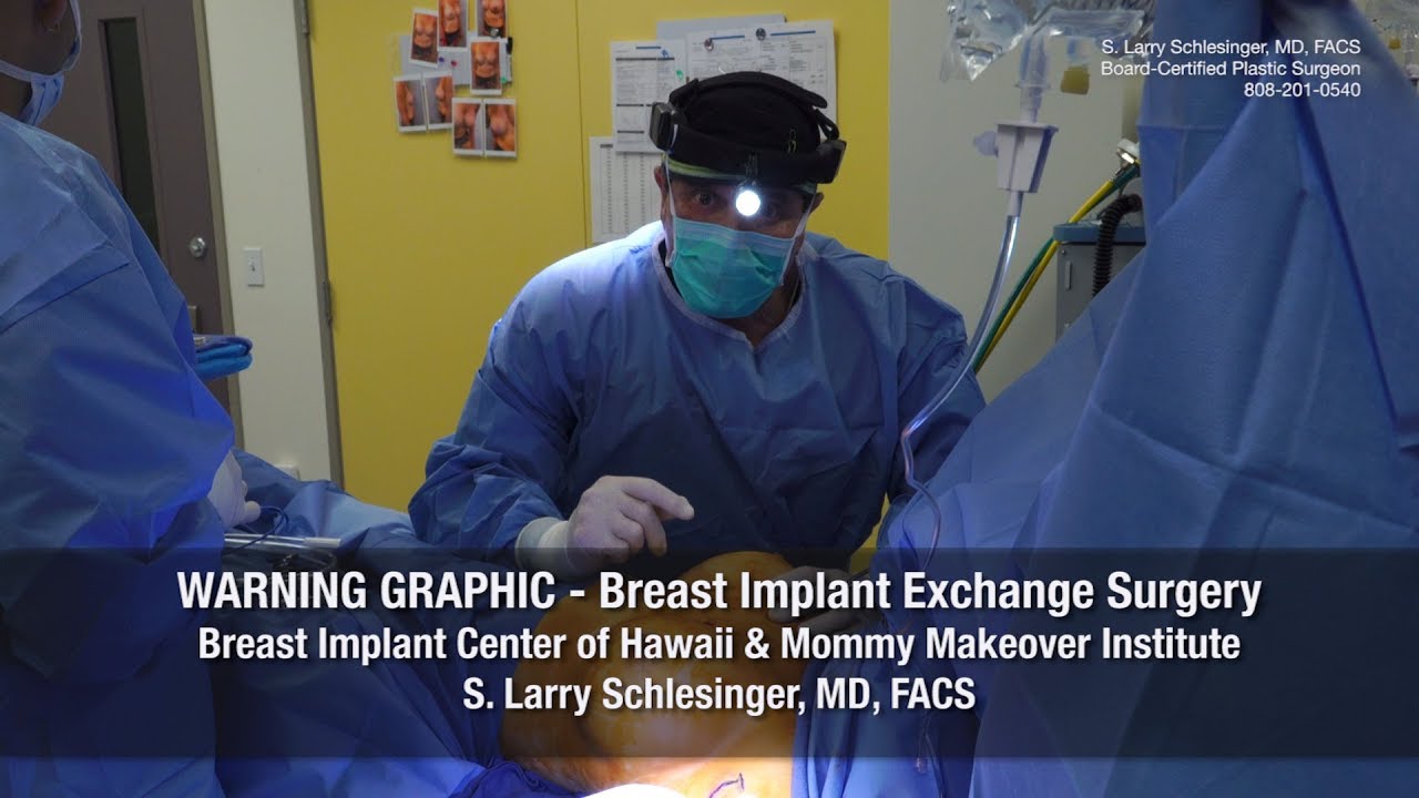 Breast Implant Exchange Surgery - Breast Implant Center of Hawaii