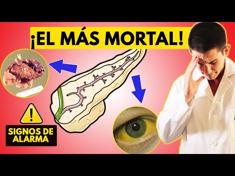 ¡PELIGRO!⚠️CÁNCER de PÁNCREAS: PRIMEROS SÍNTOMAS y DIAGNÓSTICO [Reconócelos CUANTO ANTES]