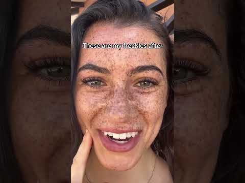 Freckles before and after #freckles