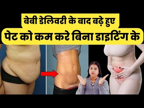 बेबी डेलिवरी के बाद बढ़े हुए पेट को कम करे बिना डाइटिंग के |delivery ke baad pet kaise kam kare|