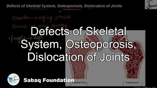 Defects of Skeletal System, Osteoporosis, Dislocation of Joints