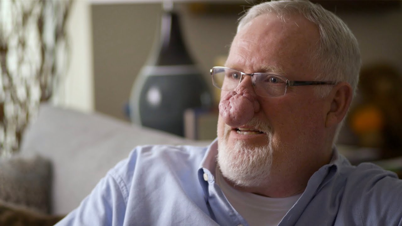 Man with facial condition sitting indoors.