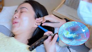 ASMR Visual Ear Cleaning & Blackhead Removal (So Satisfying & Real Sounds)