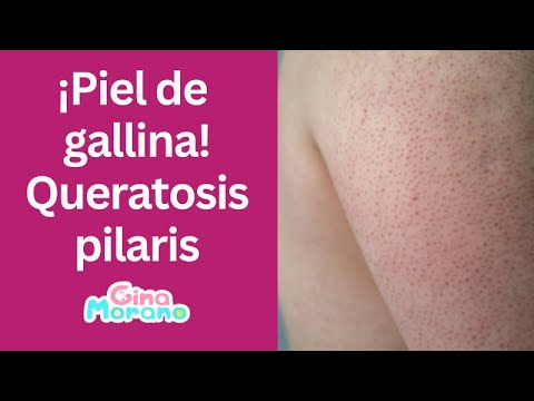 ¡Piel de gallina! Queratosis pilaris