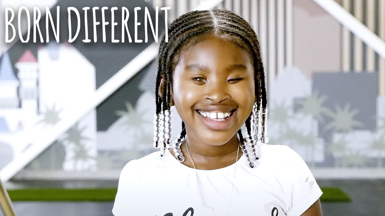 The girl born with no eyes - born different