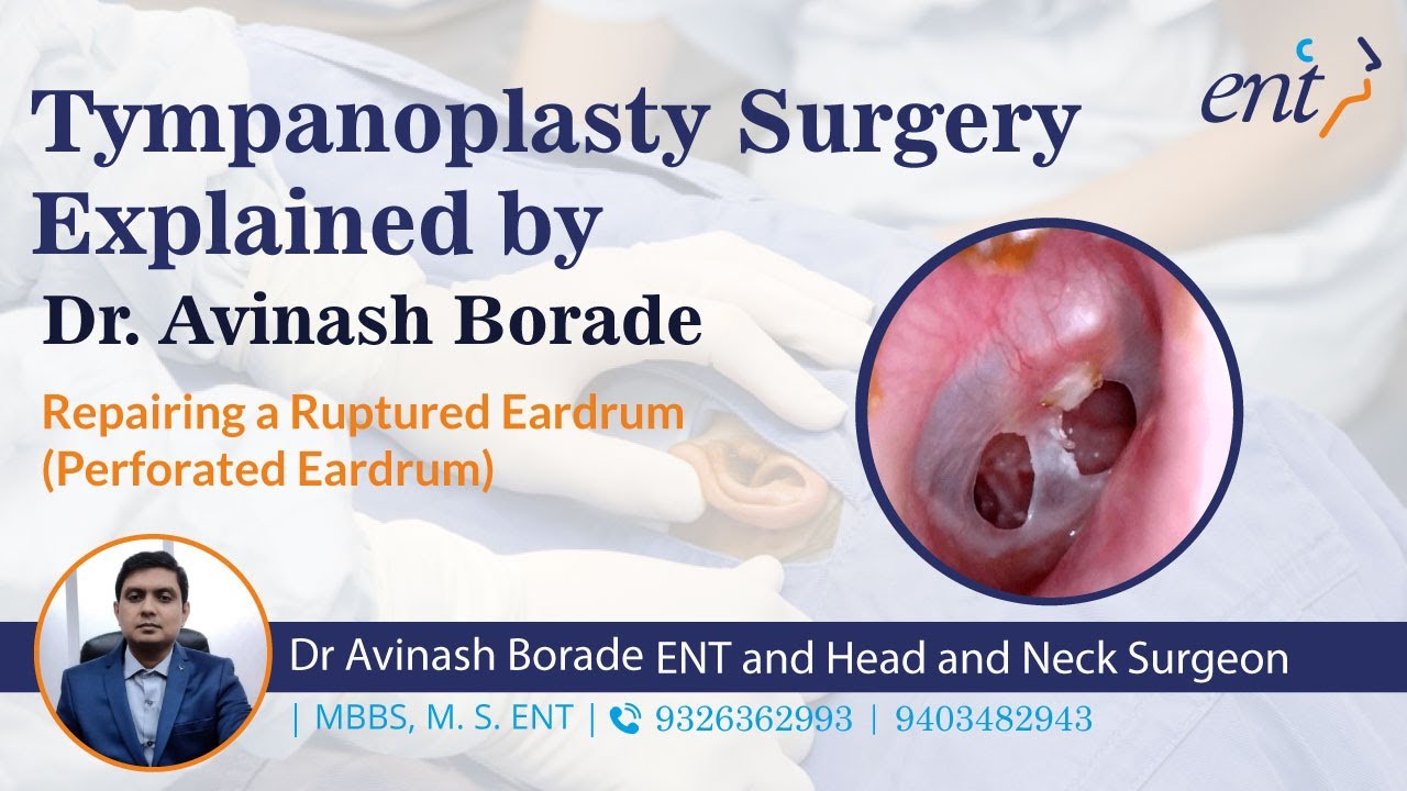 Watch Video Tympanoplasty Surgery: A Comprehensive Guide by Dr. Avinash Borade