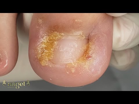 INFLAMAÇÃO NOS DOIS CANTOS DO DEDO #nails #ingrowntoenail