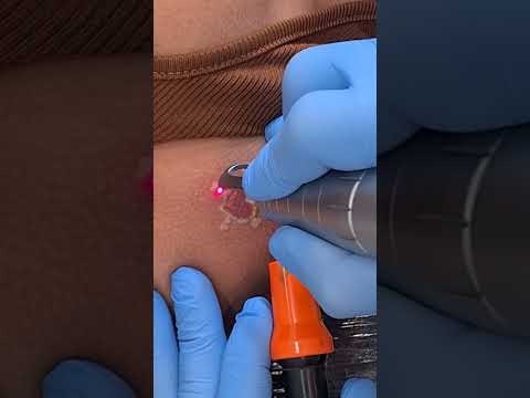 Removendo o coração a laser | Remoção de Tatuagem