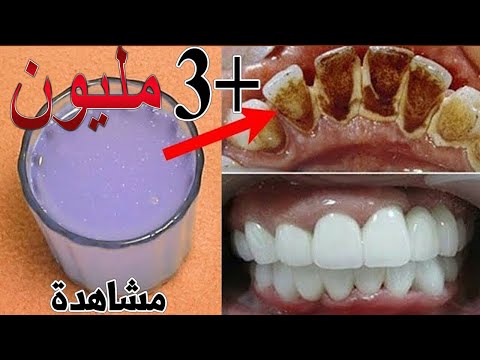 طريقة اخفوها عنك الاطباء سنوات لتبييض الاسنان في ثواني يستعملها الاغنياء فقط