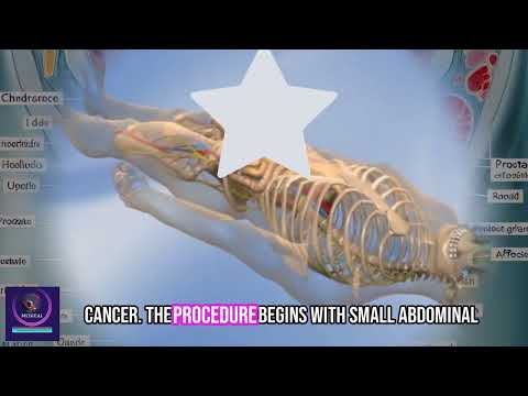 Prostate Surgery | Robotic prostatectomy Procedure | 3D Animation