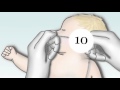 Nasopharyngeal Suctioning Techniques