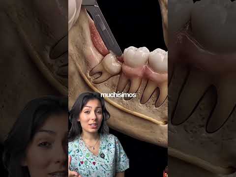 cuando te quitan LA MUELA DEL JUICIO #mueladeljuicio #muelasdeljuicio #dentista #odontologia