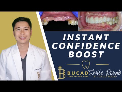 Instant Confidence Boost: Smile Design & 3D Printed Bridge!