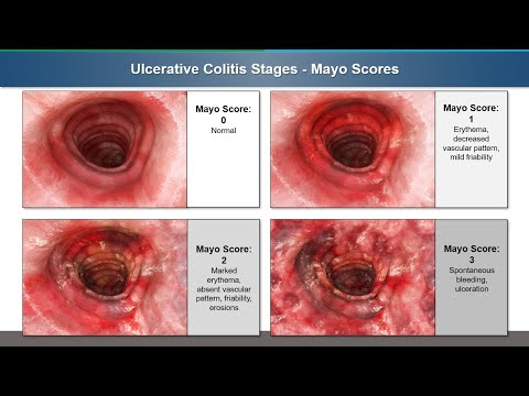 Ulcerative Colitis - Medical Malpractice Trial Summary