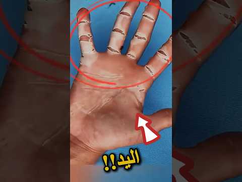 ما الذي يحدث ليد هذا الفتي! 😱🤯