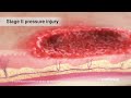 Pressure Injury Stages and Care