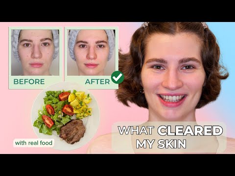 5 Months to Clear Skin | My Acne Diet Experiment