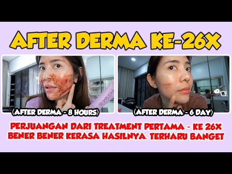 AFTER DERMA 26X - PERJUANGAN DARI TREATMENT PERTAMA KE 26X BENER BENER KERASA🥺