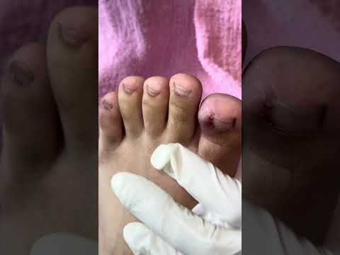 Ep_7841 Ingrown toenail removal 👣 หนูใกล้คลอด ดูแลเล็บตามคำแนะนำในคลิปนี้ 😄 (clip from Thailand)
