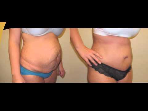 Before and after body transformation comparison.