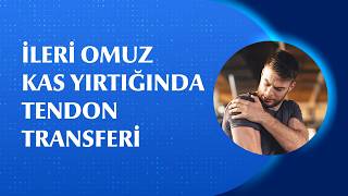 İleri Omuz Yırtıklarında Tendon Transferi Nasıl Yapılır?