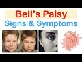 Bell's Palsy and Facial Nerve Functions