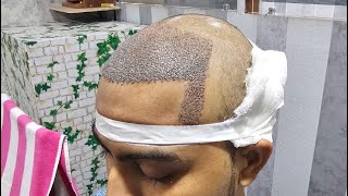 Hair Transplant 100% successful kaise hoga | Hair Transplant Ranchi by 22k Views
