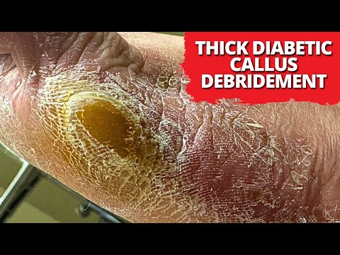 Thick Diabetic Ulcer Debridement: The Most Satisfying Cleanup!