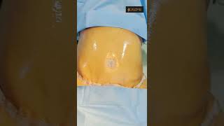 Tummy Tuck Surgery Result
