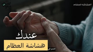 عندك هشاشة عظام 😱