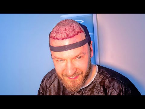 My Hair Transplant Surgery | 4850 Grafts