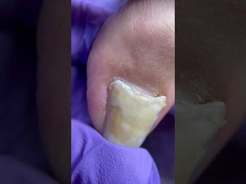Usar Zapatos Inadecuados 👟 Puede Tener Consecuencias 🥲