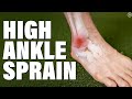 Syndesmotic Injury Assessment and Management