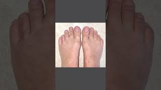 YES, WE CAN LENGTHEN TOES! 📸#brachymetatarsia #brachymetatarsiasurgery #brachymetatarsia