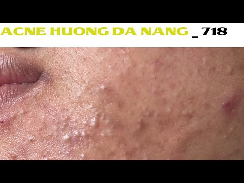 Acne Treatment Huong Da Nang# 718 |   #Remove Blackheads