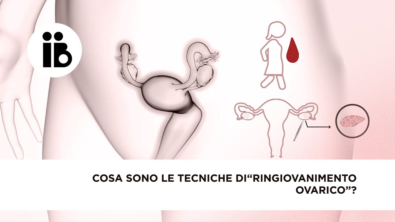 Cosa sono le tecniche di “ringiovanimento ovarico”?
