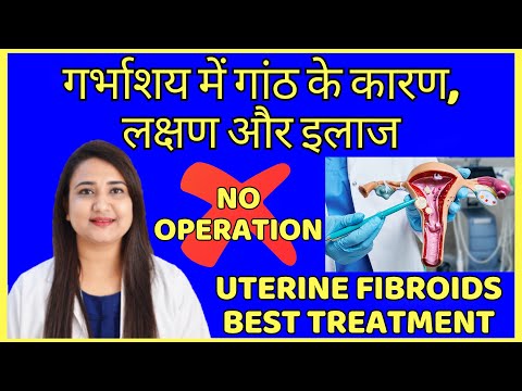 गर्भाशय में गांठ के कारण, लक्षण और इलाज | UTERINE FIBROIDS BEST TREATMENT