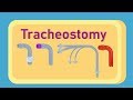 Tracheostomy Procedures and Complications