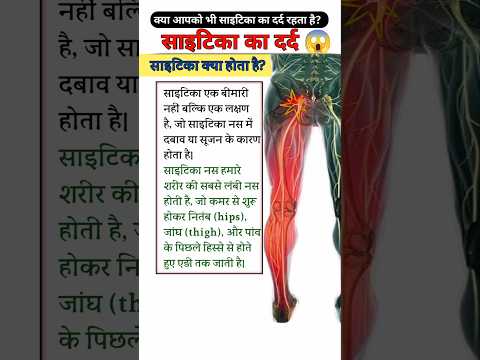 Sciatica Ka Dard 😭😱🔥 #viralvideo #viralshorts #physiodrdeepaksoni #sciatica