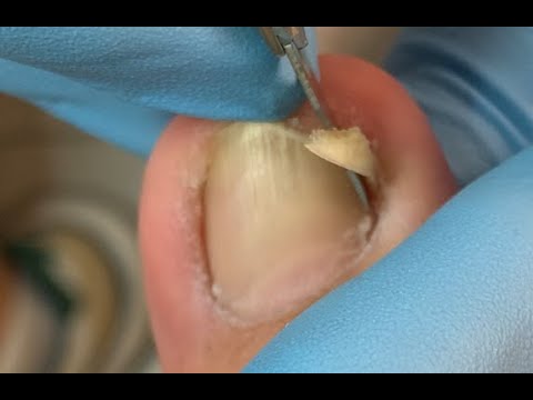 How to repair nails