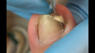 How to repair nails