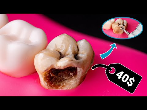 AMAZING Tooth Restoration