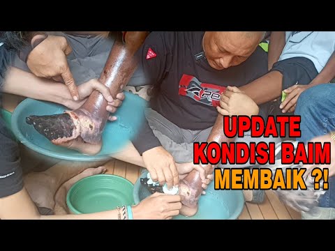 KONDISI TER UPDATE  !!! Bocil Korban gig1tan Ranjau darat / Rodos