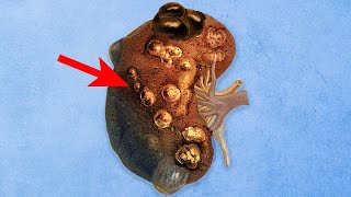 What Was Growing In His Kidneys Started Growing All Over His Body